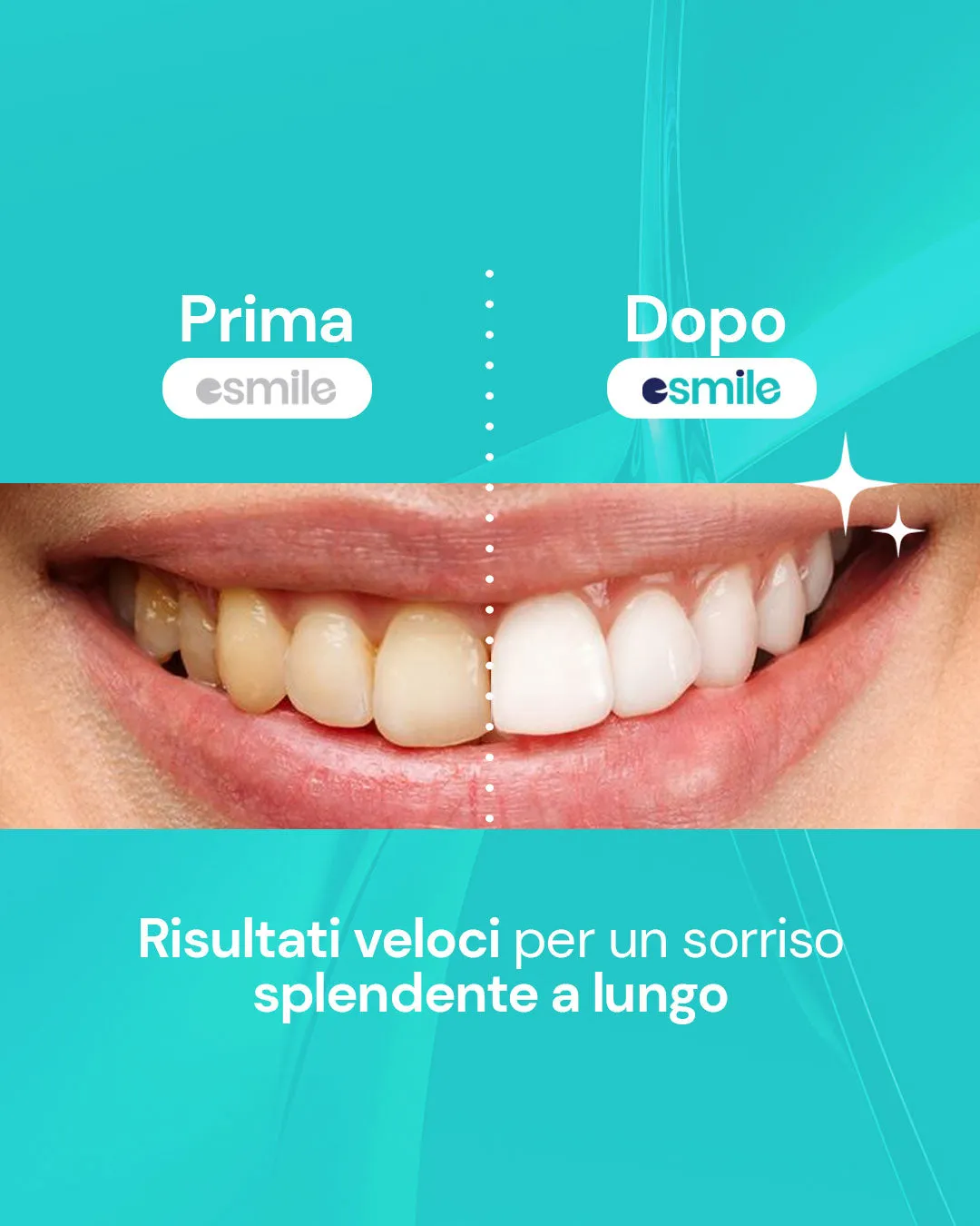 esmile Easy Smile bundle kit sbiancante + carbone cocco