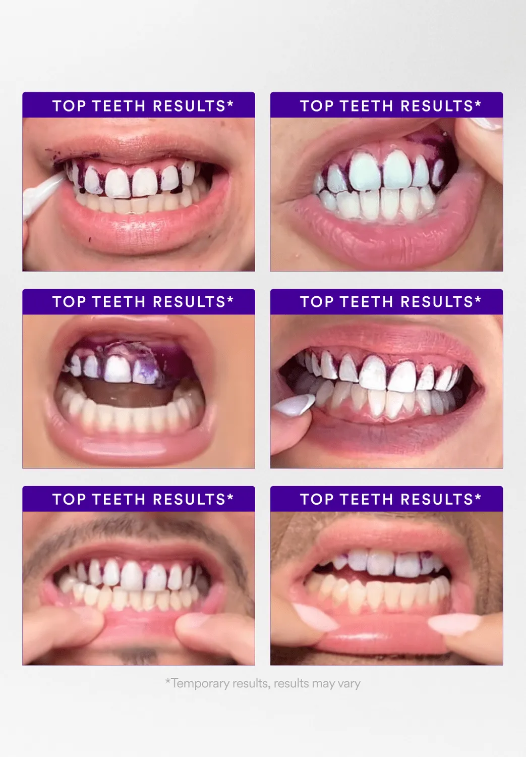 Hismile Starter Bundle kit sbiancante dentifricio strisce